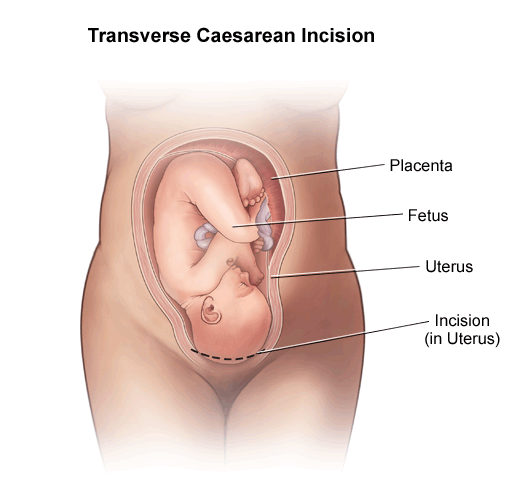 Cesarean Rate Is Too High