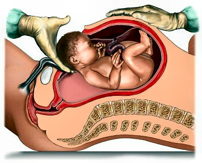 Cesarean’s For the Wrong Reasons